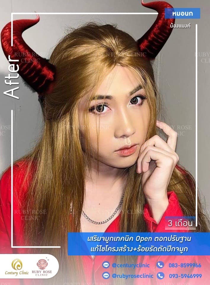 Century-รีวิว-เสริมจมูก 1#367