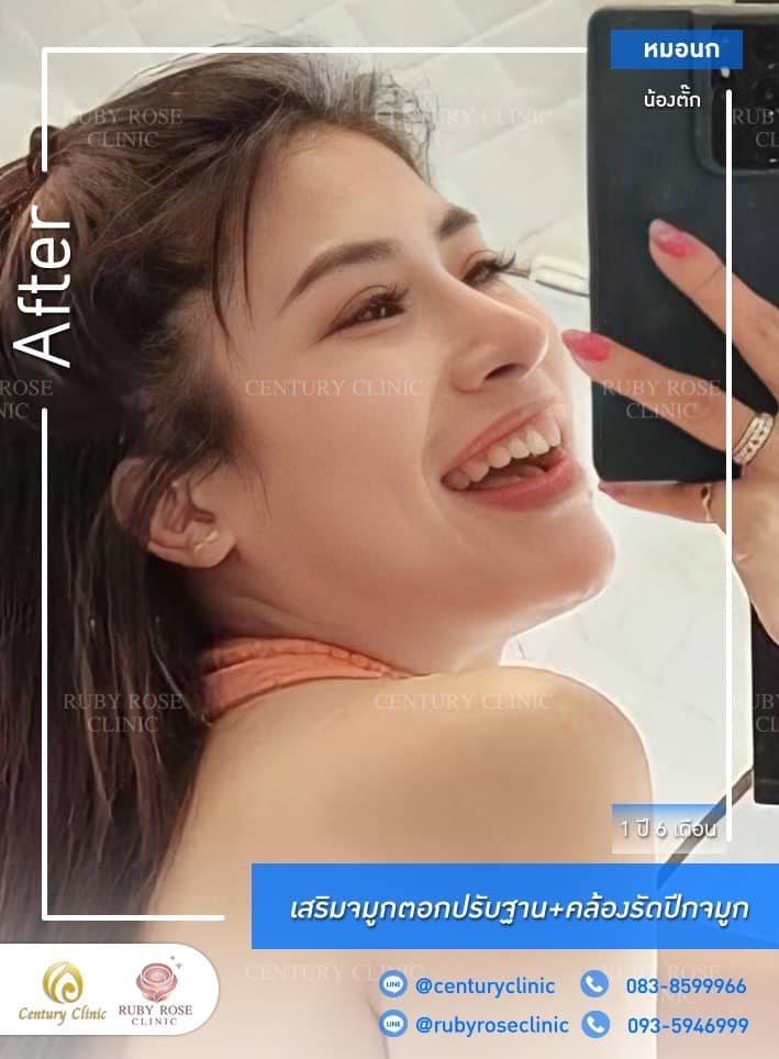 Century-รีวิว-เสริมจมูก 1#372