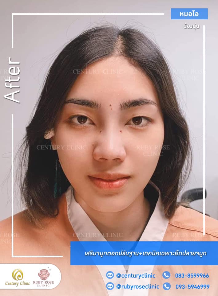 รีวิว เสริมจมูก #374 , Century Clinic Thailand Century-รีวิว-เสริมจมูก 1#374