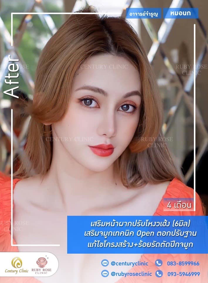 Century-รีวิว-เสริมจมูก 1#375