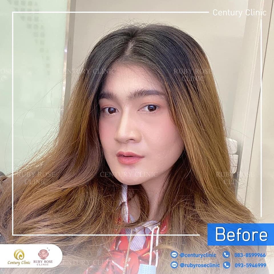 Century-รีวิว-เสริมจมูก 1#379