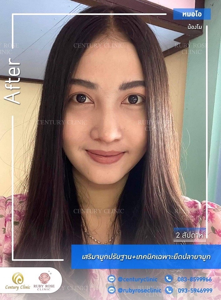Century-รีวิว-เสริมจมูก 1#388