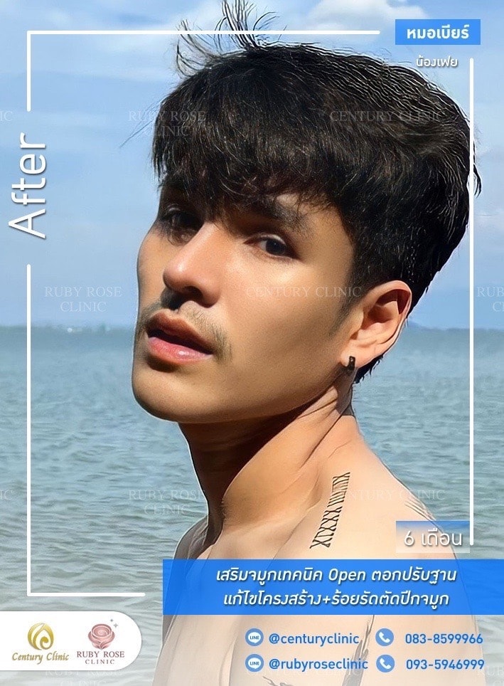 Century-รีวิว-เสริมจมูก 1#389