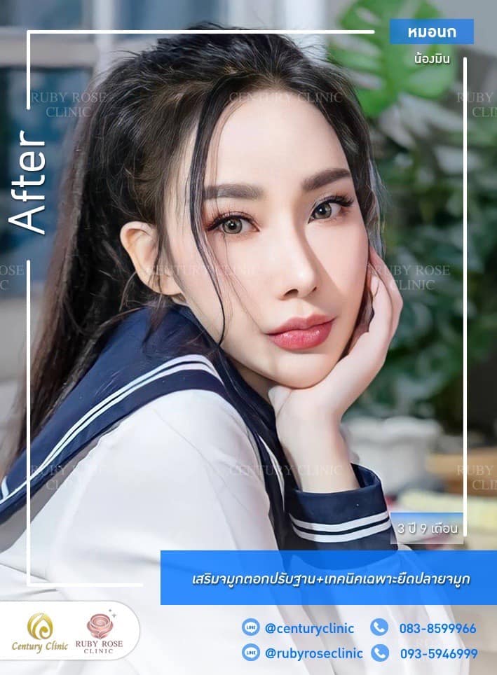 รีวิว เสริมจมูก #391 , Century Clinic Thailand Century-รีวิว-เสริมจมูก 1#391