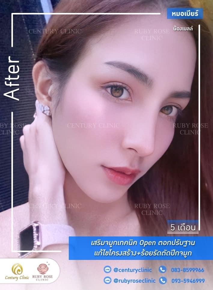 Century-รีวิว-เสริมจมูก 1#393