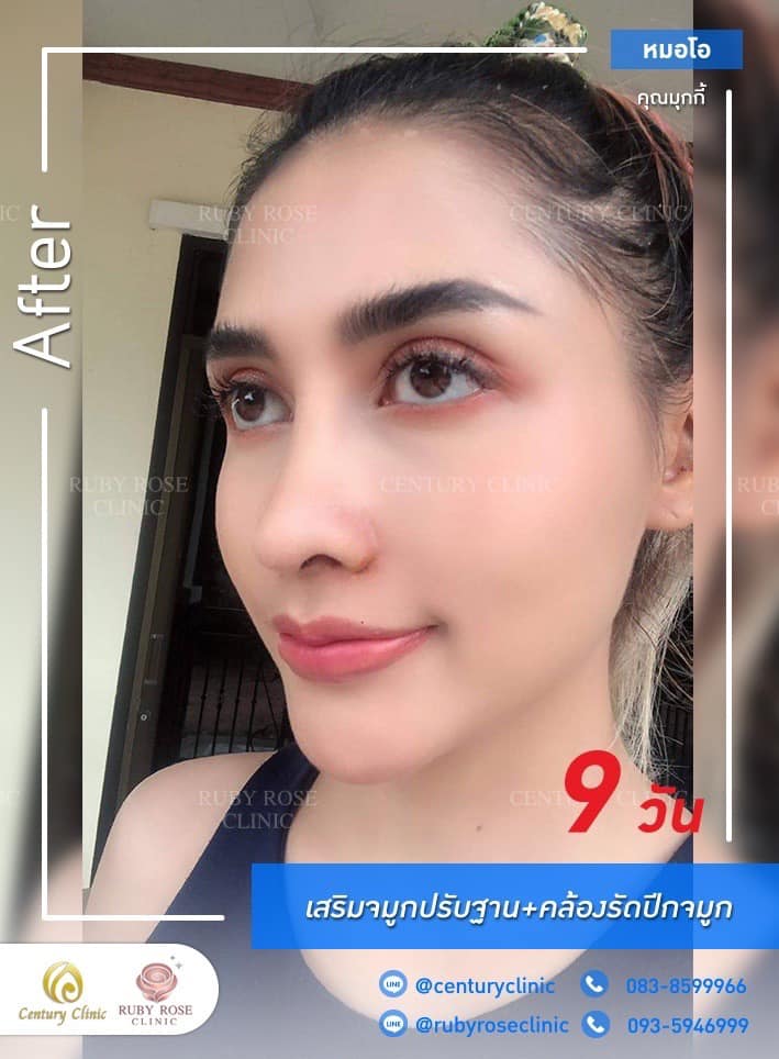 Century-รีวิว-เสริมจมูก 1#417