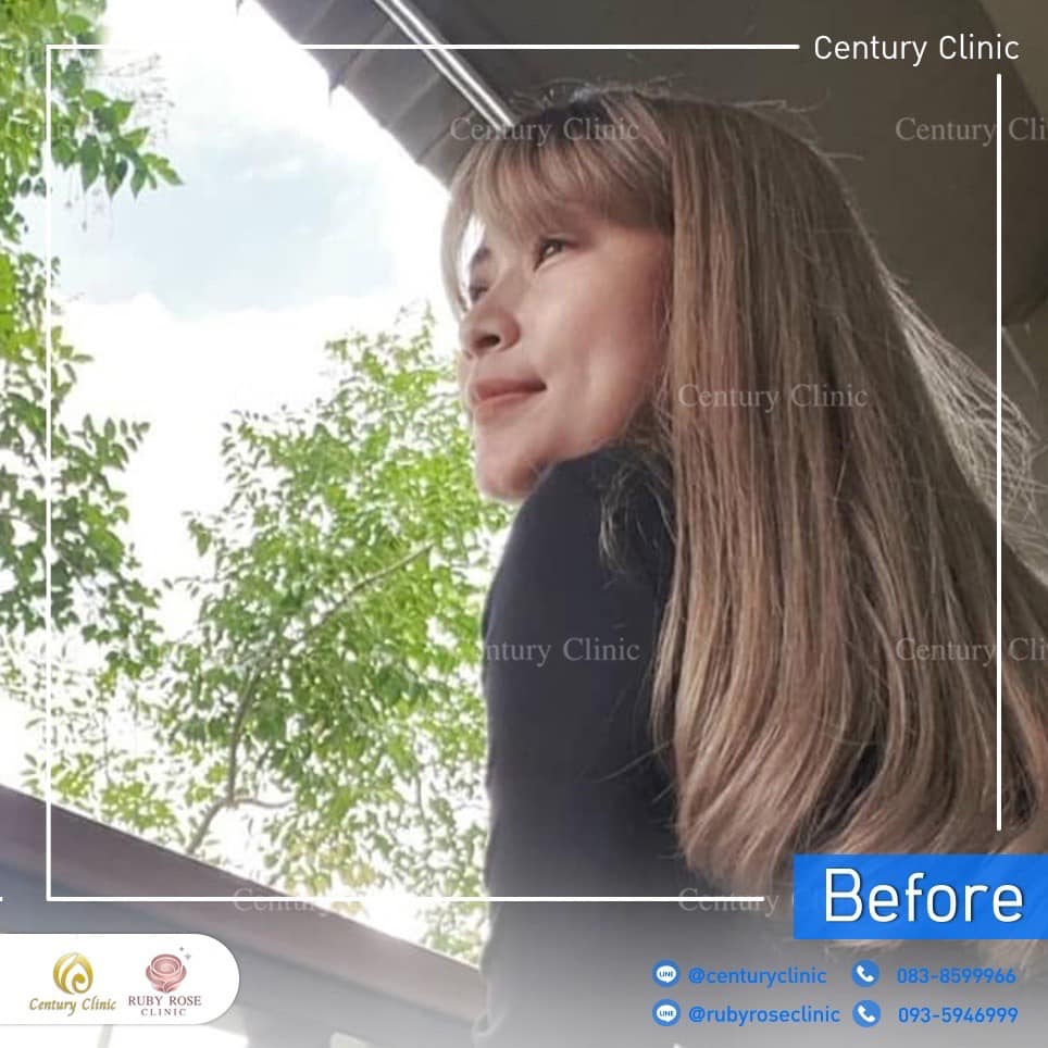 Century-รีวิว-เสริมจมูก 2#372
