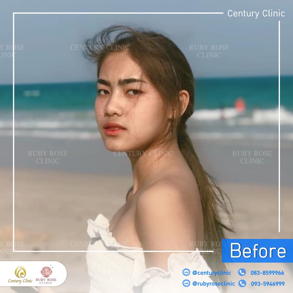 รีวิว เสริมจมูก #374 , Century Clinic Thailand Century-รีวิว-เสริมจมูก 2#374