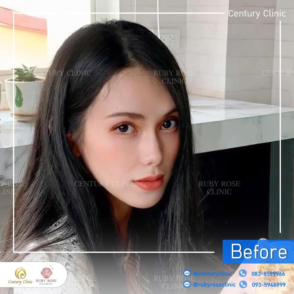 Century-รีวิว-เสริมจมูก 2#375