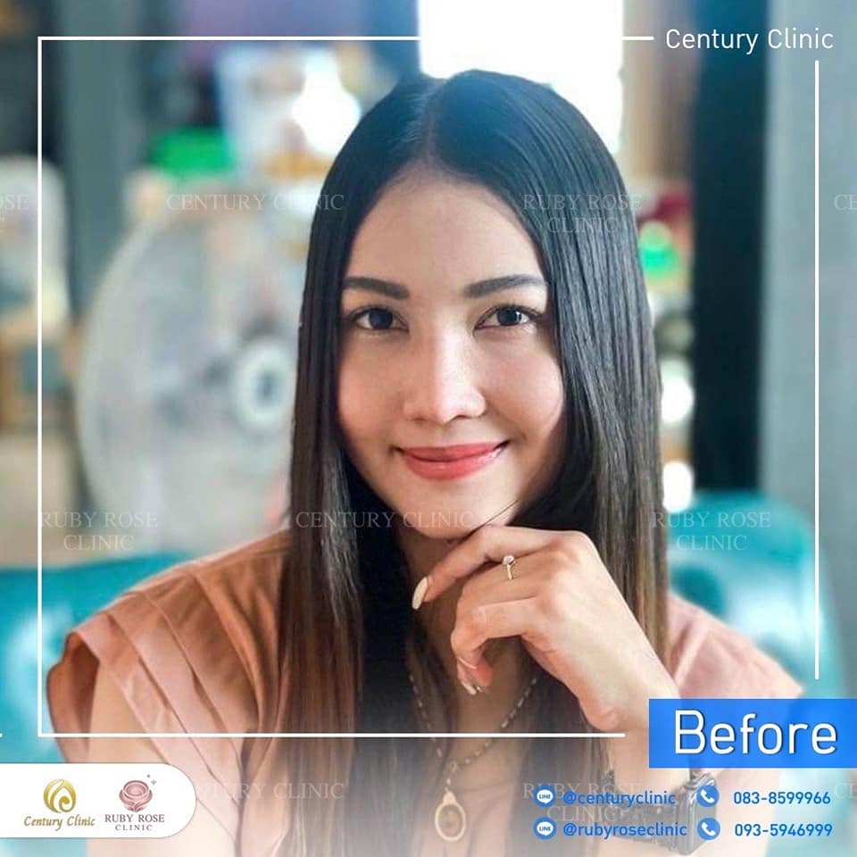 Century-รีวิว-เสริมจมูก 2#388