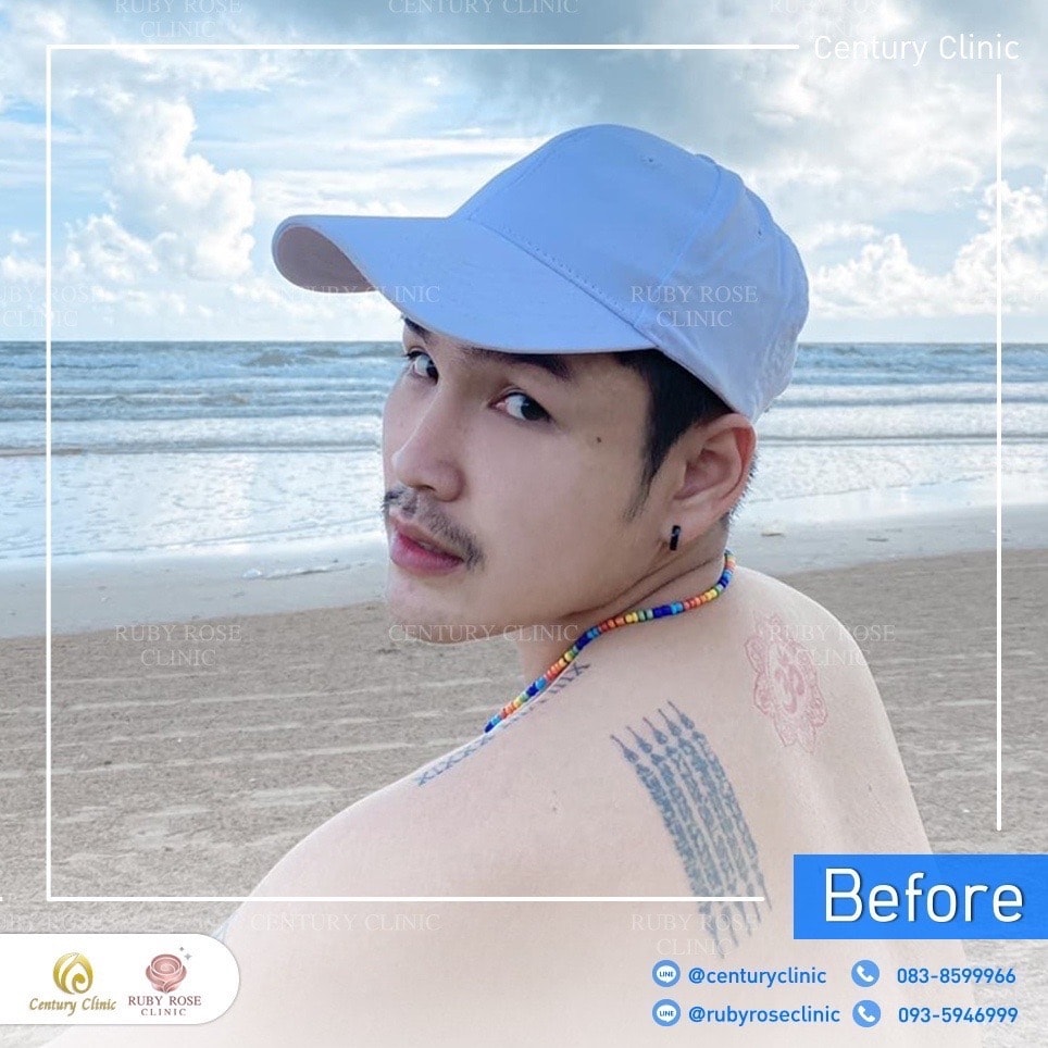 Century-รีวิว-เสริมจมูก 2#389