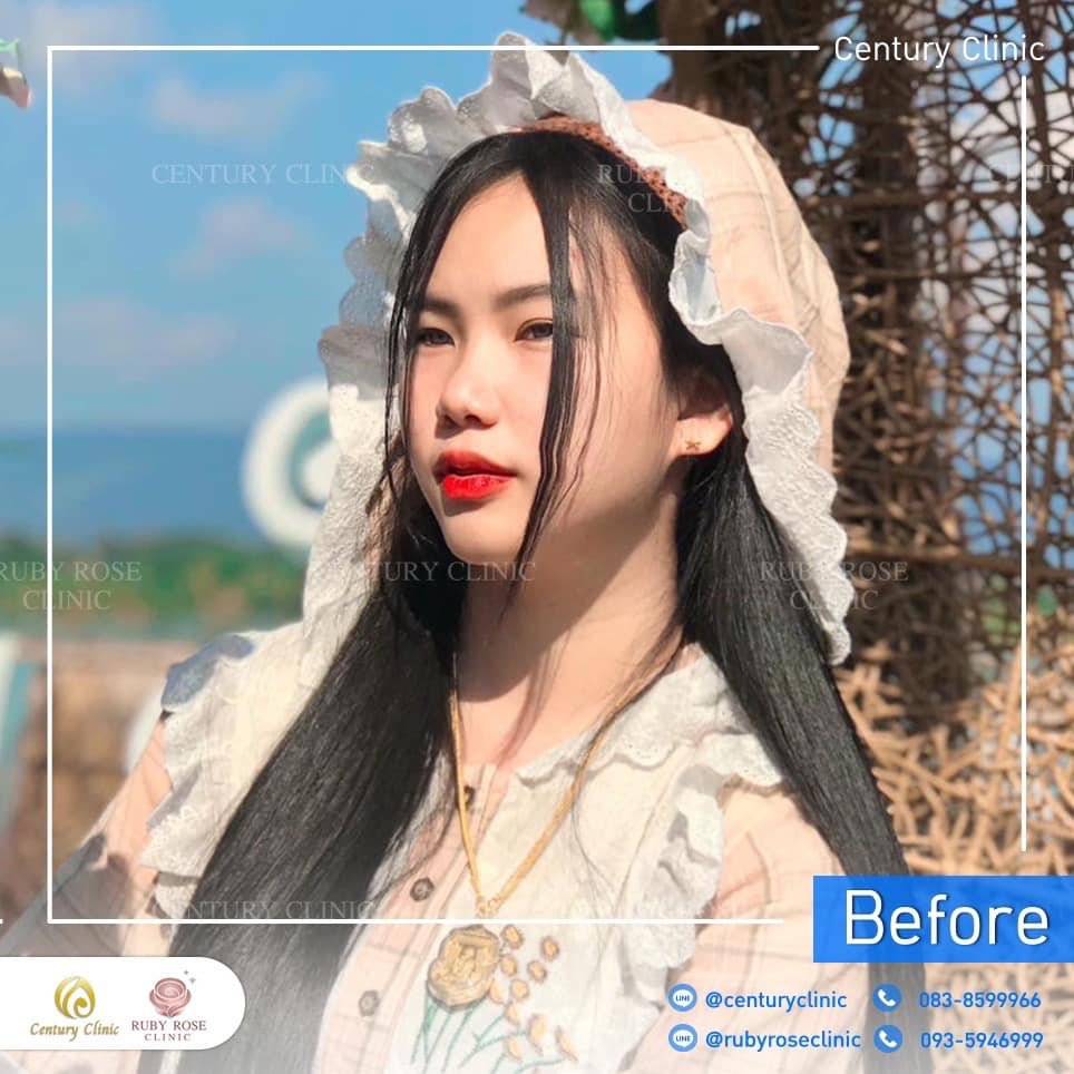 Century-รีวิว-เสริมจมูก 2#416