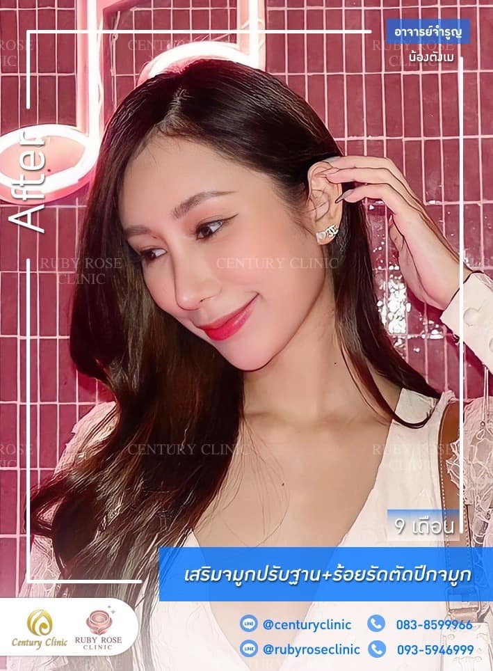 Century-รีวิว-เสริมจมูก #364