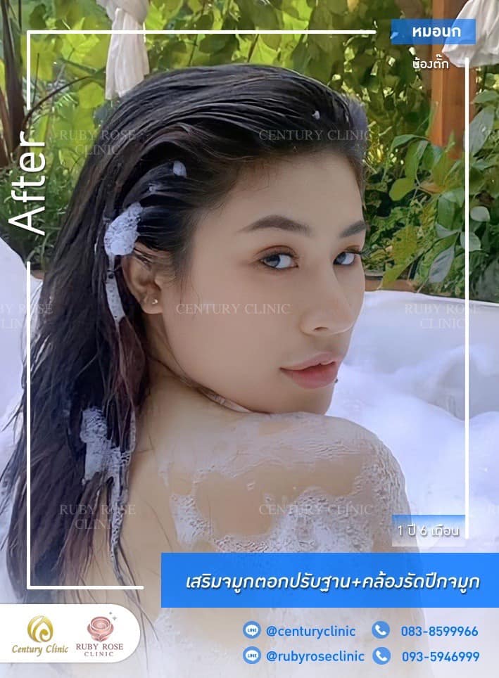 Century-รีวิว-เสริมจมูก #372