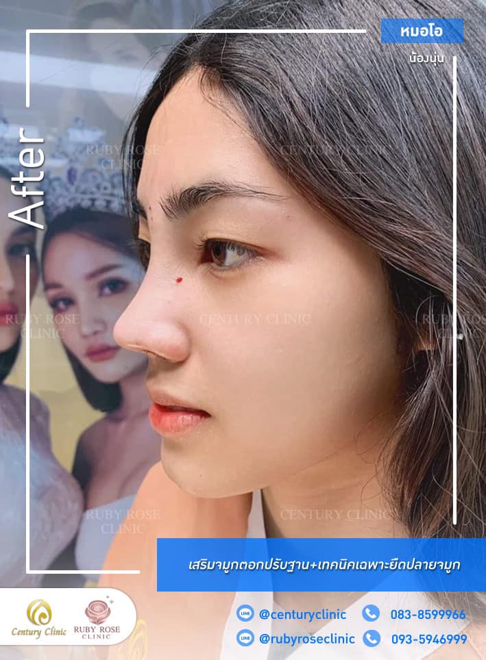 Century-รีวิว-เสริมจมูก #374