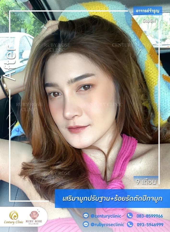 Century-รีวิว-เสริมจมูก #379