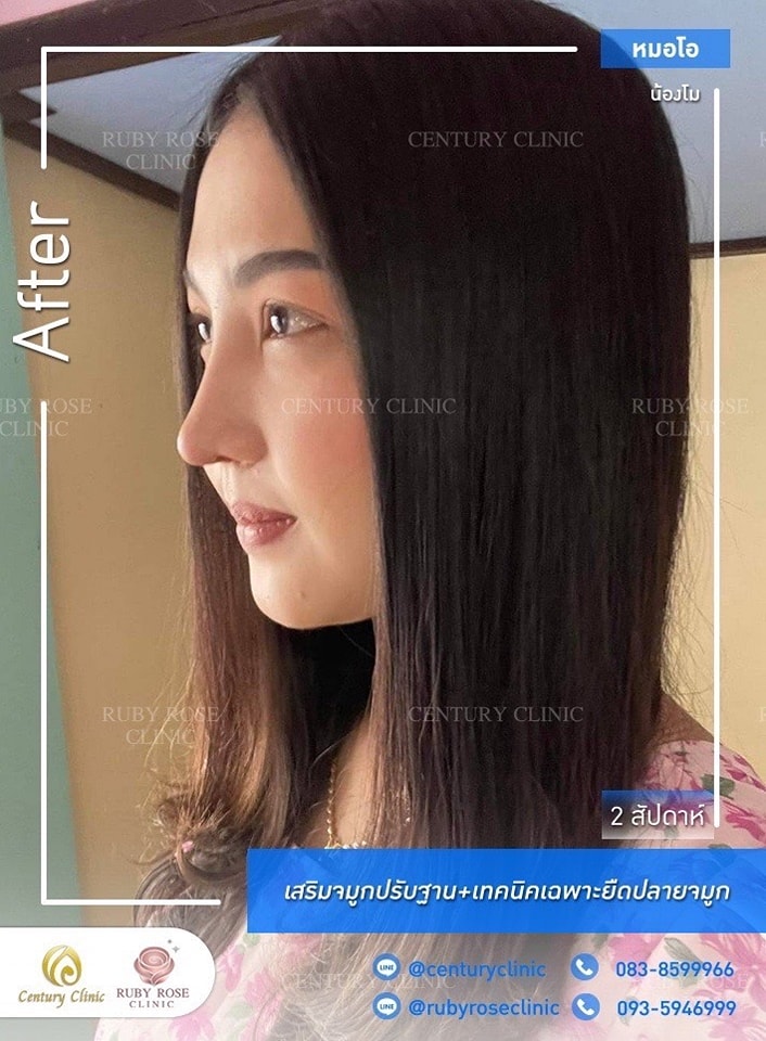 รีวิว เสริมจมูก #388