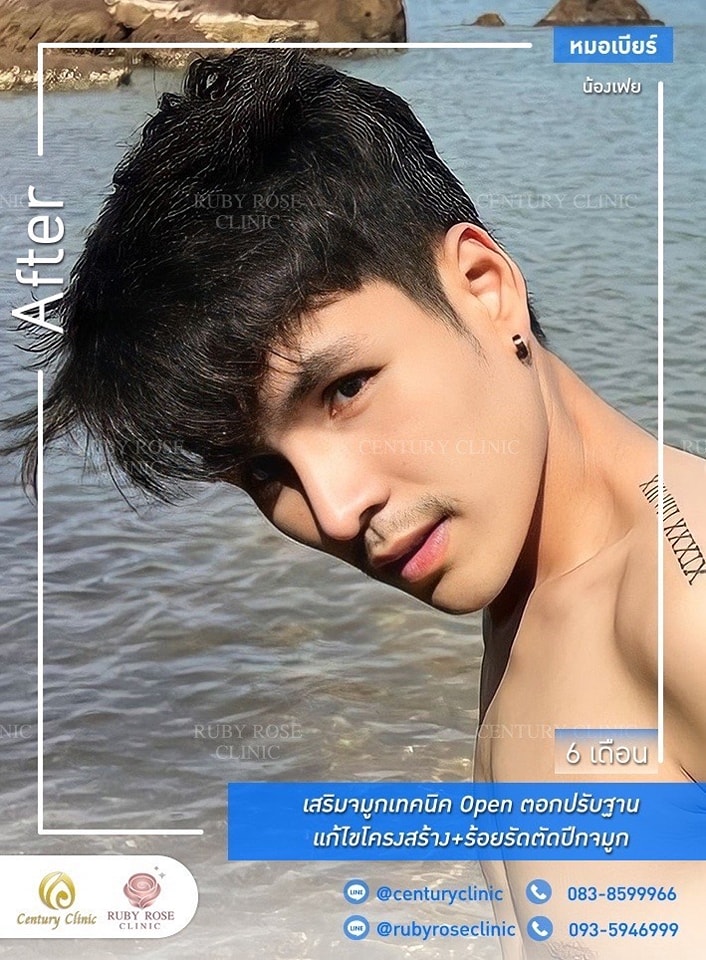 Century-รีวิว-เสริมจมูก #389