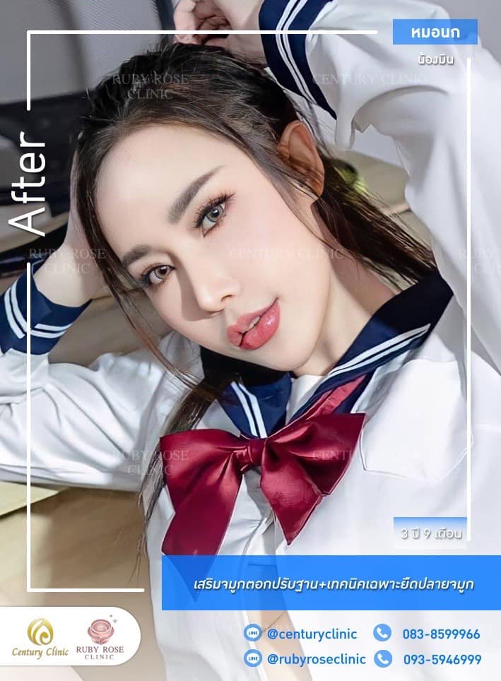 Century-รีวิว-เสริมจมูก #391