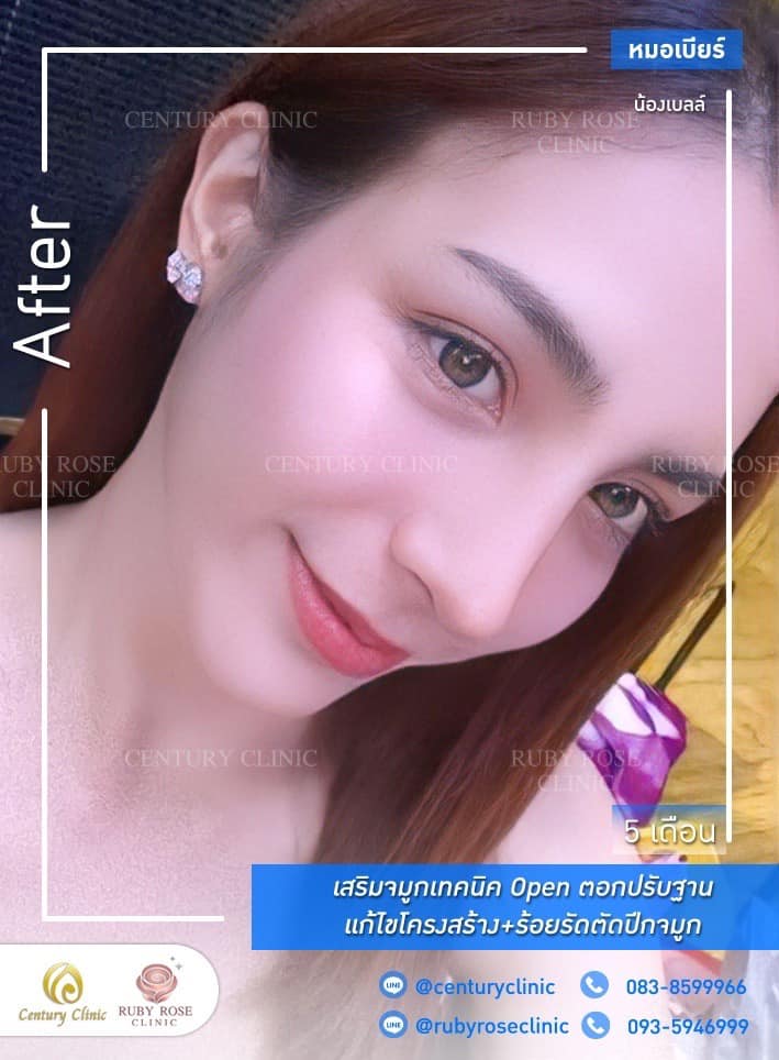 Century-รีวิว-เสริมจมูก #393