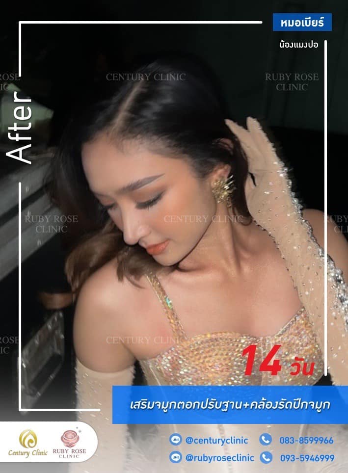 Century-รีวิว-เสริมจมูก #404