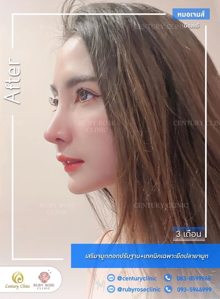 Century-รีวิว-เสริมจมูก #406