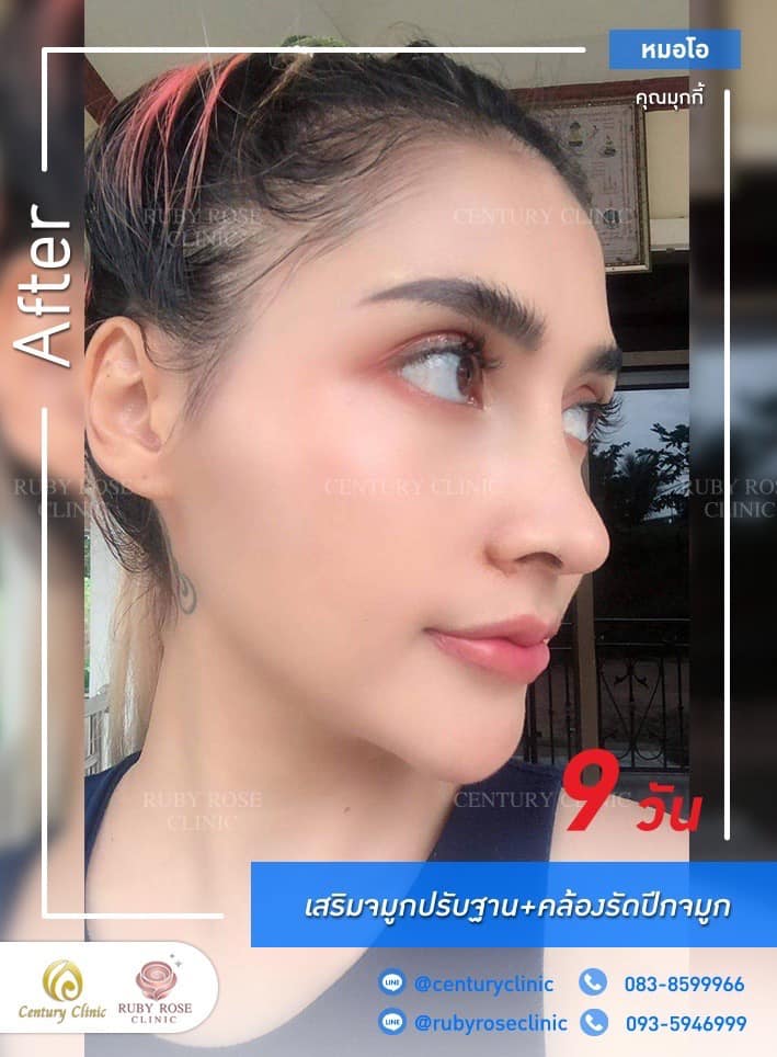 Century-รีวิว-เสริมจมูก #417