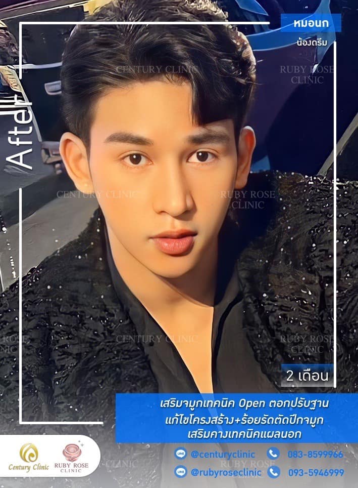 รีวิว เสริมจมูก #381 , Century Clinic Thailand Century-รีวิว-เสริมจมูก-คาง 1#381
