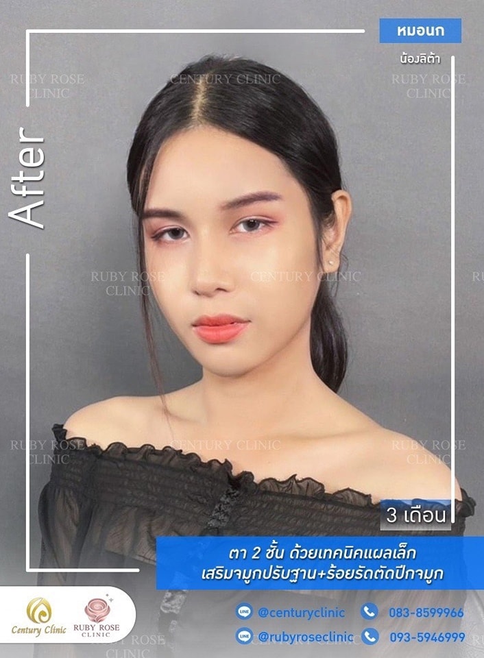 Century-รีวิว-เสริมจมูก-ตา 1#396