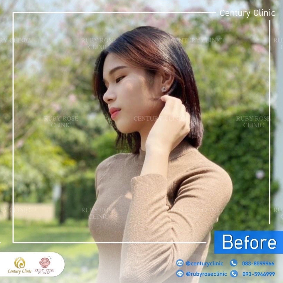 Century-รีวิว-เสริมจมูก-ตา 2#396