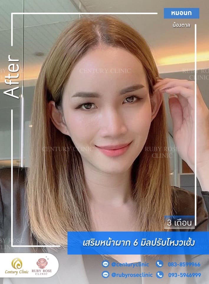 Century รีวิว เสริมหน้าผากปรับโหวงเฮ้ง 1#19