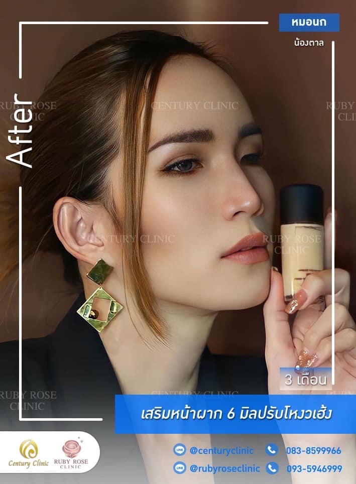 Century รีวิว เสริมหน้าผากปรับโหวงเฮ้ง #19