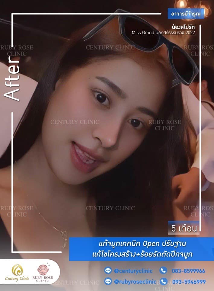 Century-รีวิว-แก้จมูก 1#360