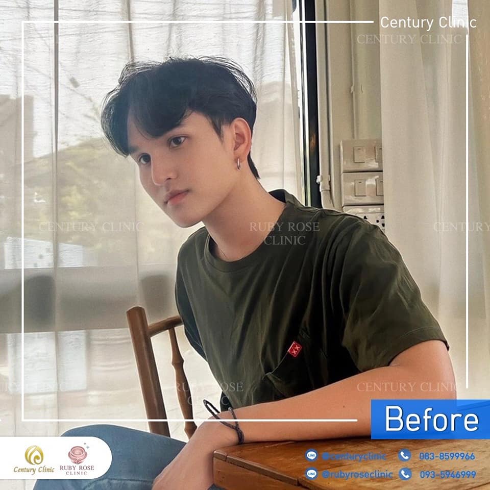Century-รีวิว-แก้จมูก 1#362