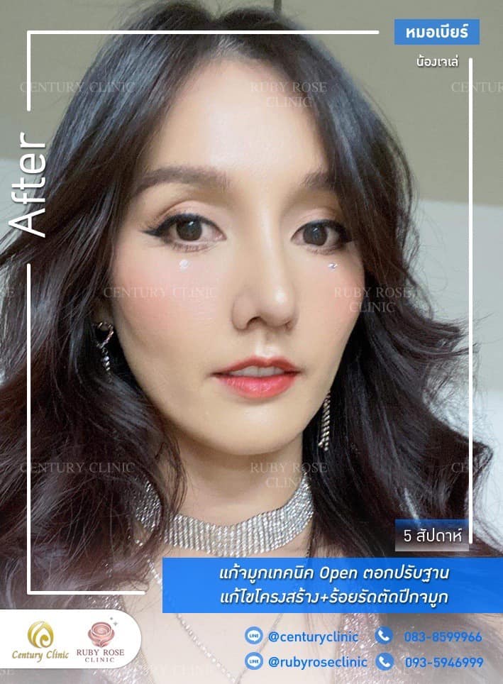 รีวิว แก้จมูก #365 , Century Clinic Thailand Century-รีวิว-แก้จมูก 1#365