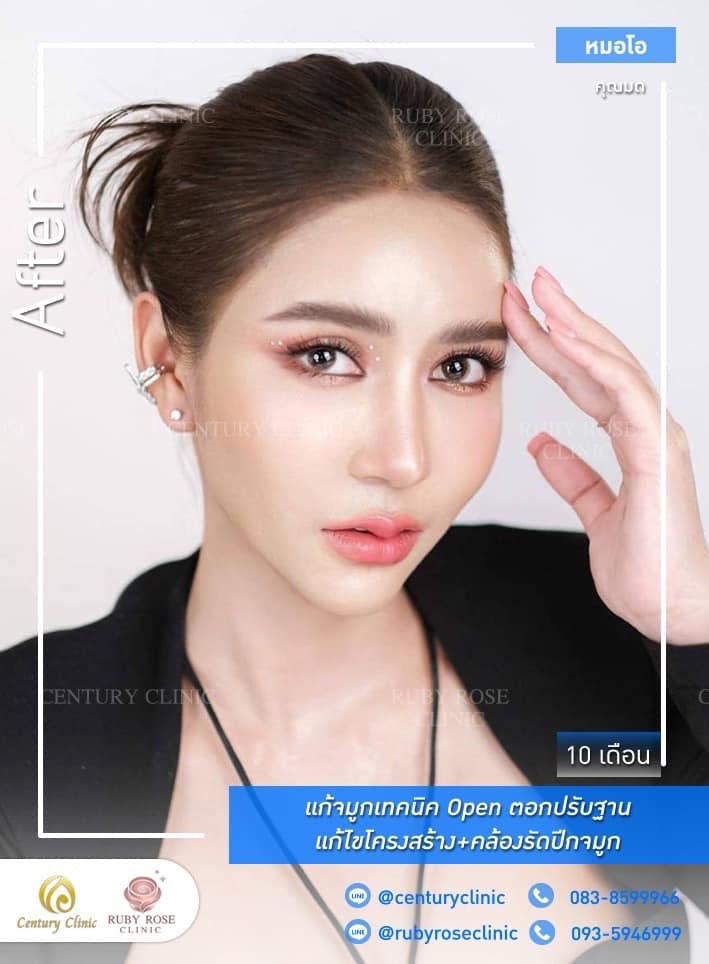 Century-รีวิว-แก้จมูก 1#366