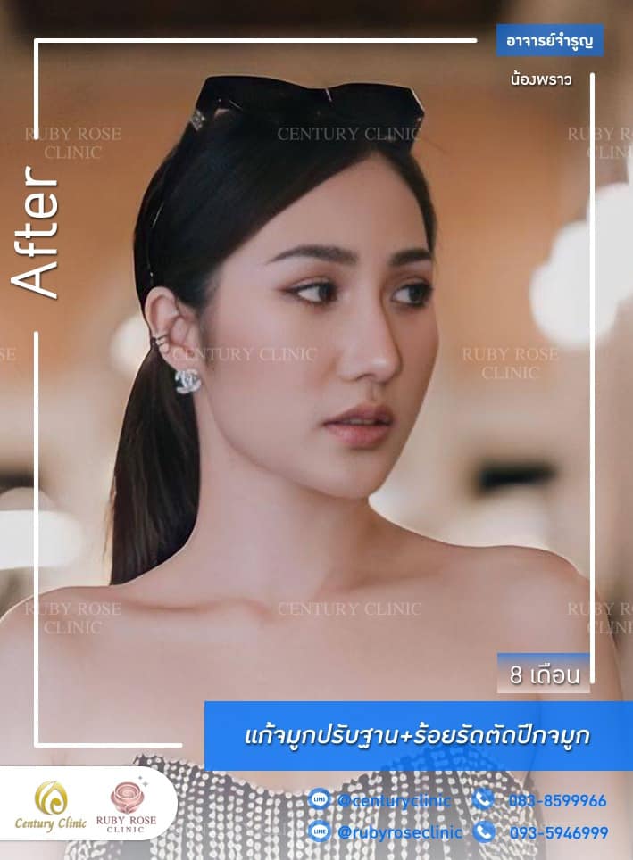 รีวิว แก้จมูก #369 , Century Clinic Thailand Century-รีวิว-แก้จมูก 1#369