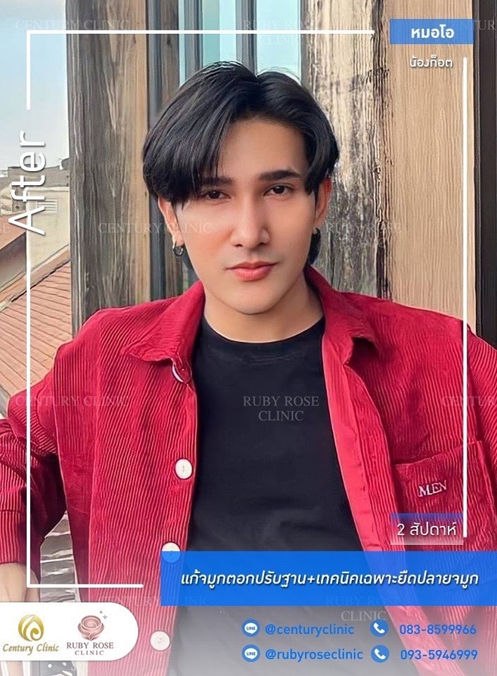 รีวิว แก้จมูก #377 , Century Clinic Thailand Century-รีวิว-แก้จมูก 1#377
