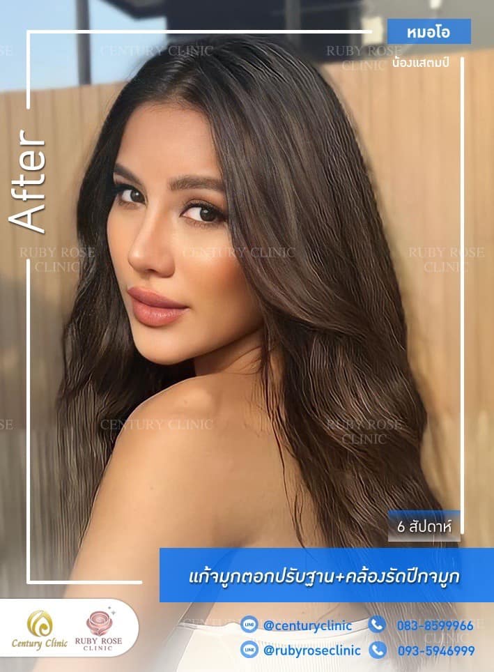 Century-รีวิว-แก้จมูก 1#382