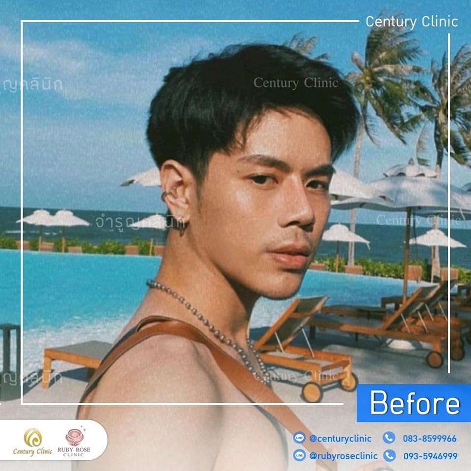 รีวิว แก้จมูก #383 , Century Clinic Thailand Century-รีวิว-แก้จมูก 1#383