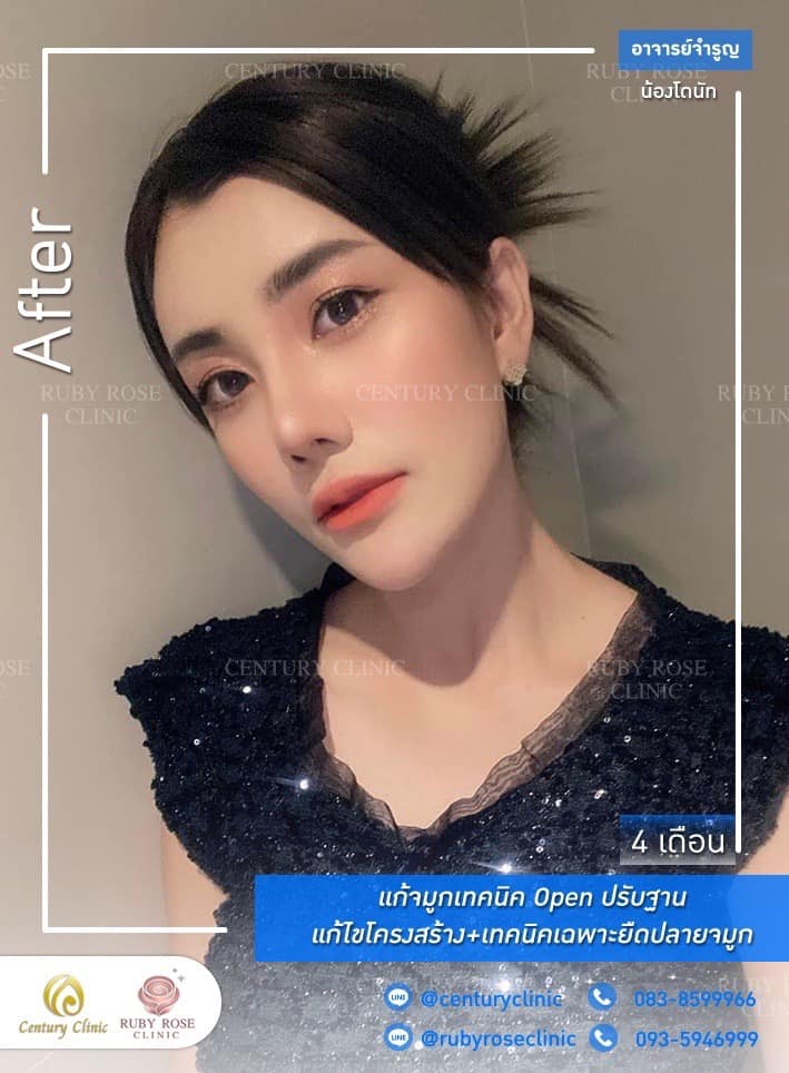 Century-รีวิว-แก้จมูก 1#394