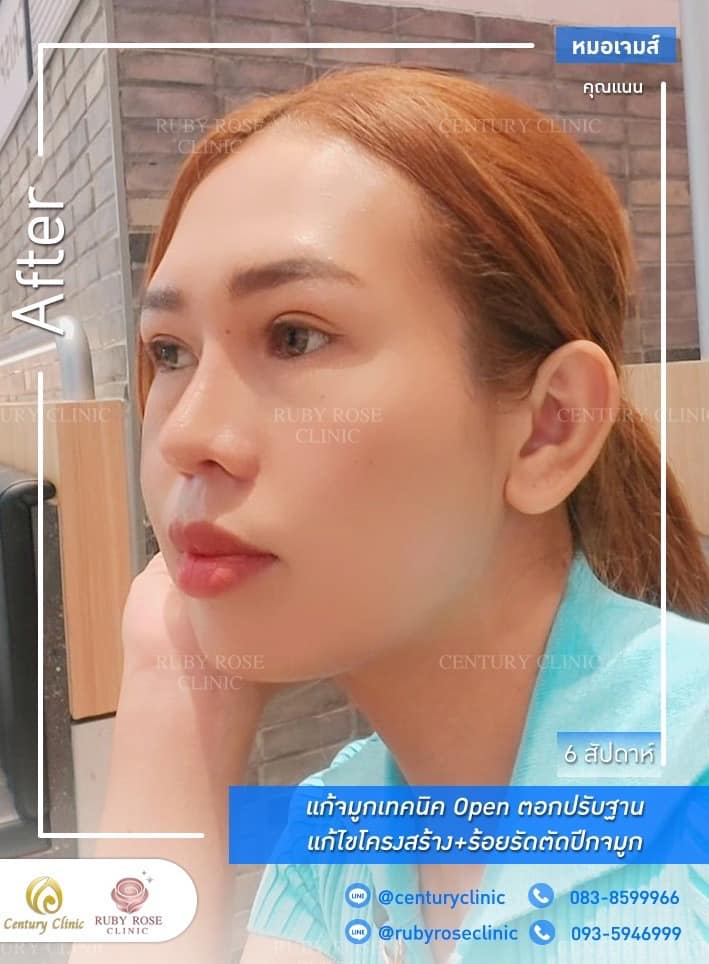 Century-รีวิว-แก้จมูก 1#395