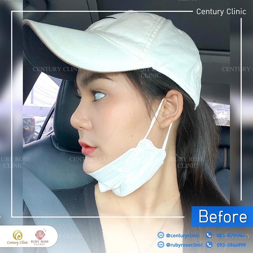 Century-รีวิว-แก้จมูก 1#397