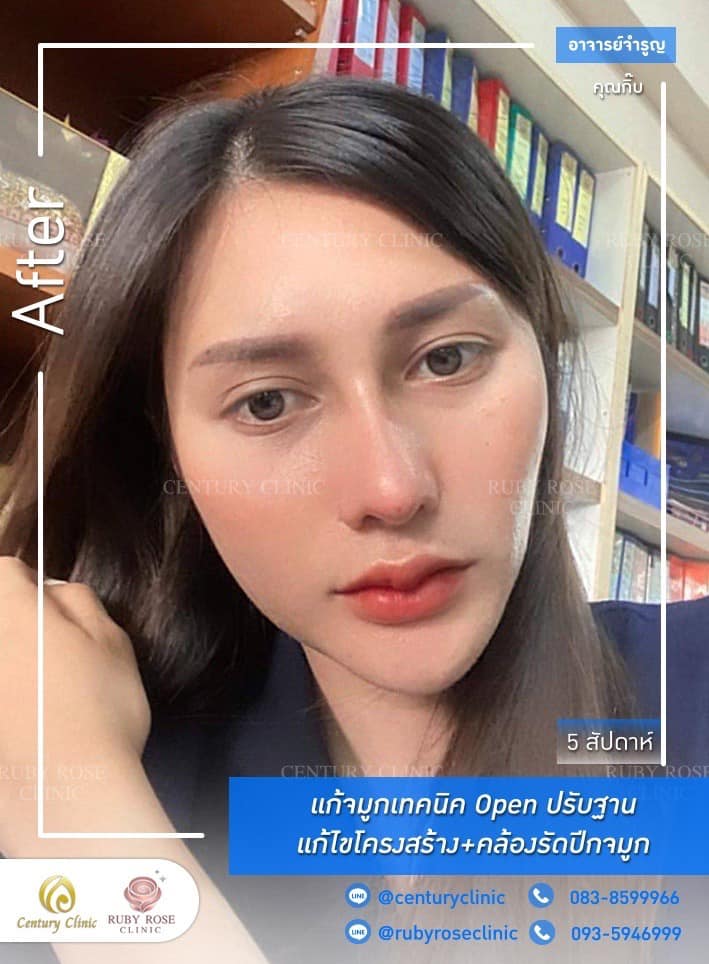 Century-รีวิว-แก้จมูก 1#399