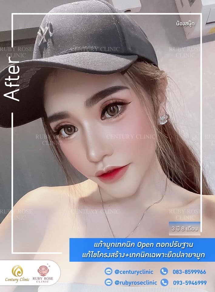 Century-รีวิว-แก้จมูก 1#401