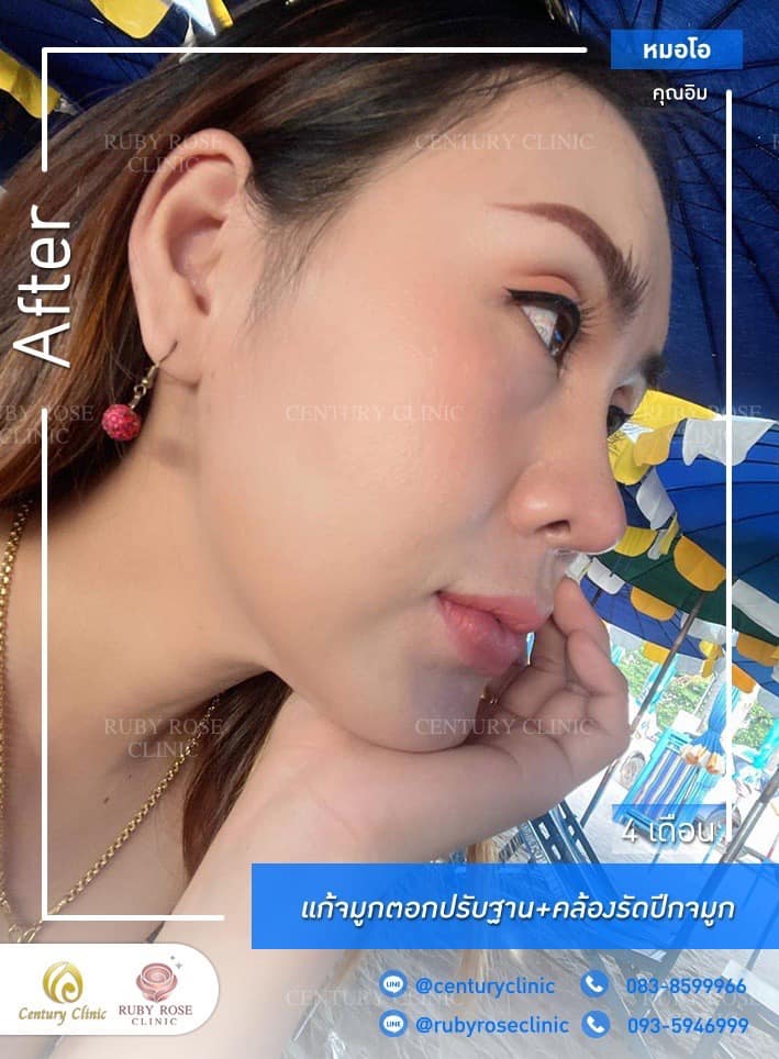 Century-รีวิว-แก้จมูก 1#402