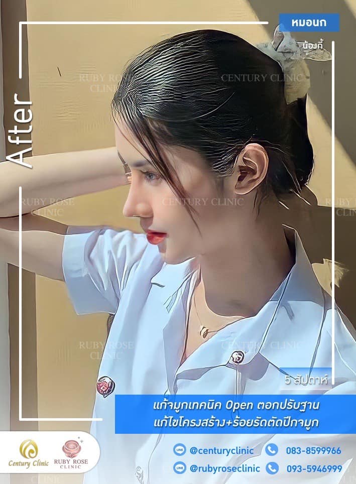 Century-รีวิว-แก้จมูก 1#407
