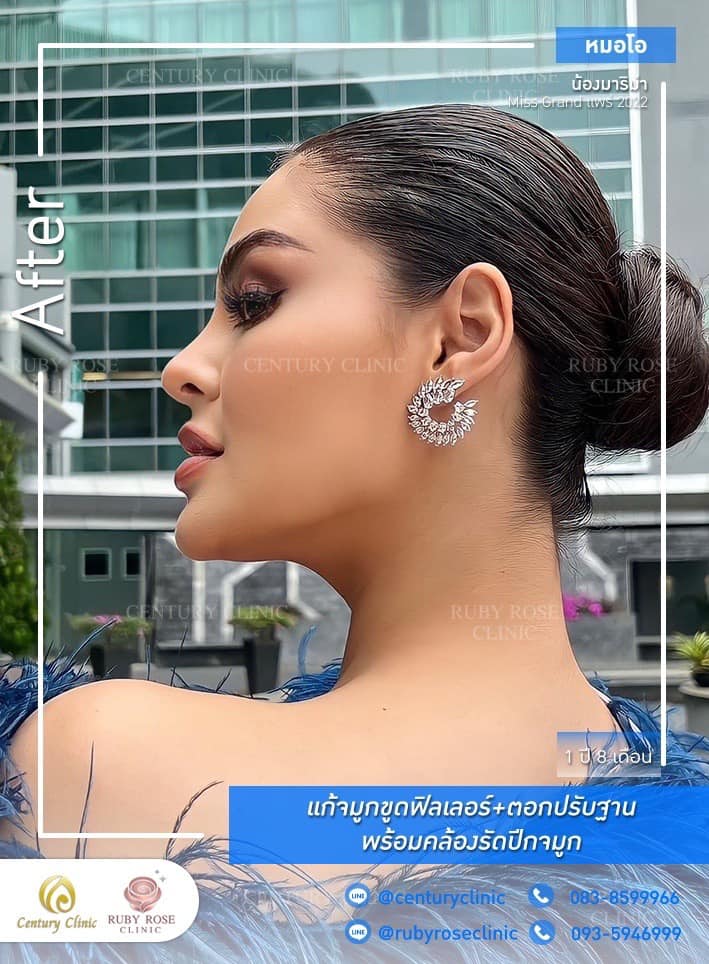 Century-รีวิว-แก้จมูก 1#412