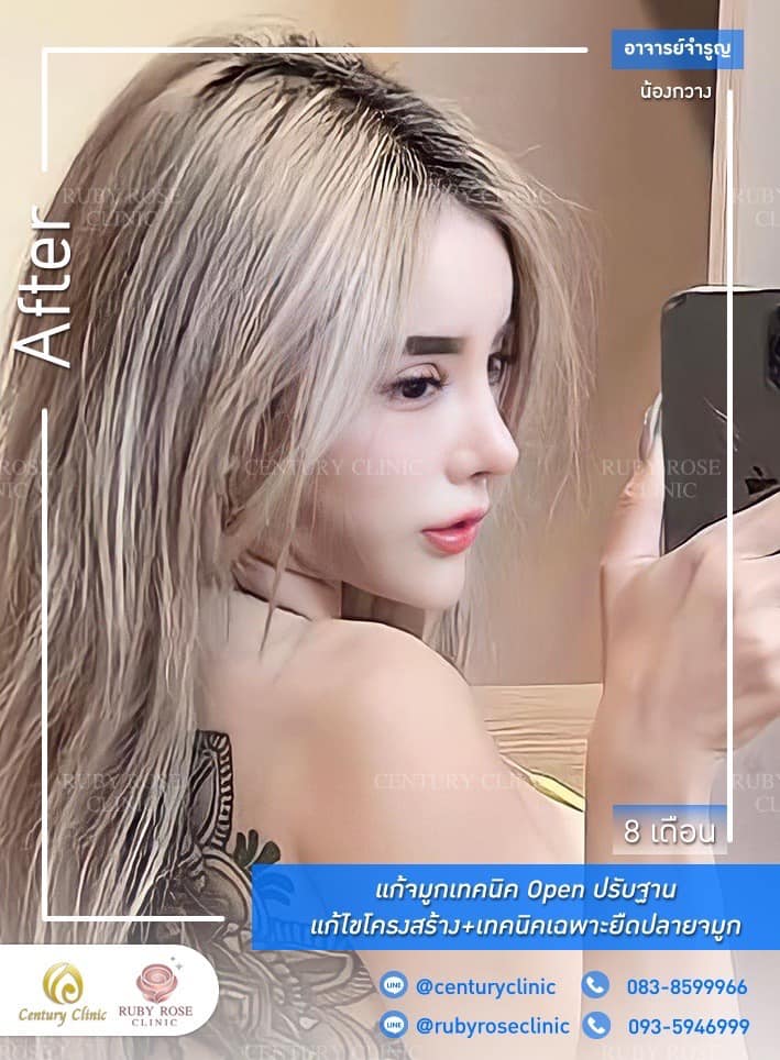 Century-รีวิว-แก้จมูก 1#414