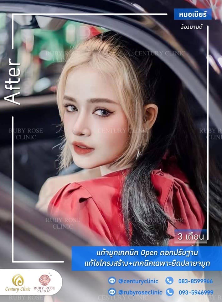 Century-รีวิว-แก้จมูก 1#418